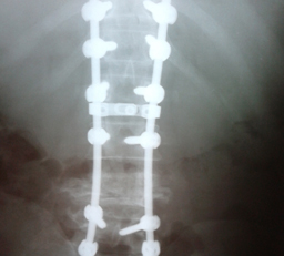 Spine Surgeon in Delhi